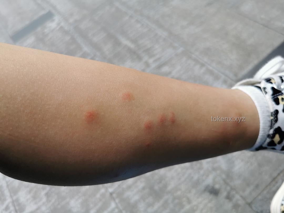 被蚊子咬了能迅速止痒的4个方法，希望大家都用不上！蚊子叮咬,止痒方法,家庭急救,预防措施,自然疗法